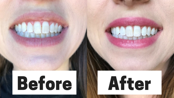 teeth whitening review before and after Teeth Whitening for Sensitive Teeth
